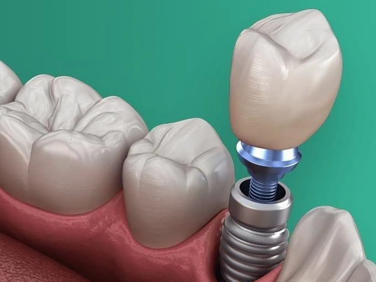 Implant dentar cu bont și coroană, între doi dinți naturali, într-o ilustrație 3D